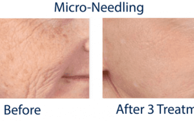 Is Microneedling right for you?