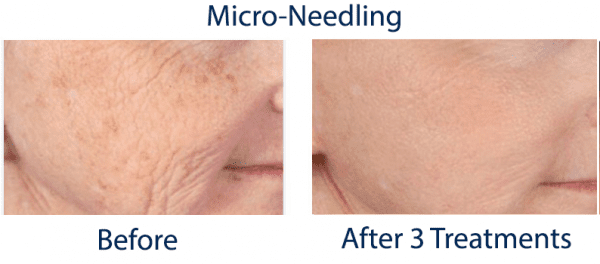 Microneedling Before and After Pictures New York, NY