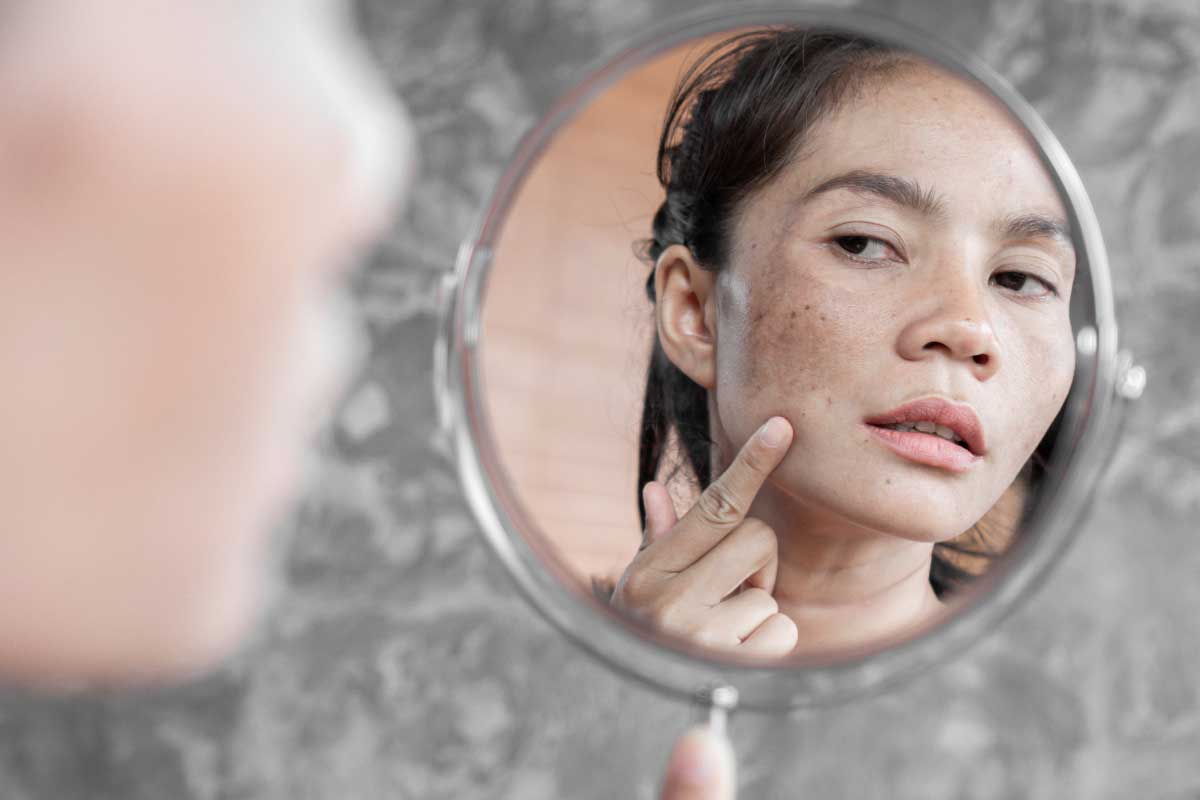 Acne Treatments in New York, NY