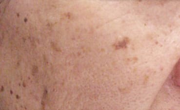 Dr. Dennis Gross Dermatology Before & After Pictures in New York, NY