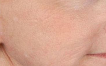 Dr. Dennis Gross Dermatology Before & After Pictures in New York, NY