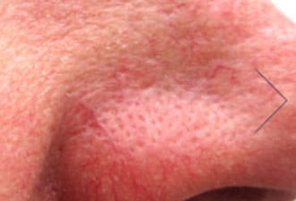 Dr. Dennis Gross Dermatology Before & After Pictures in New York, NY