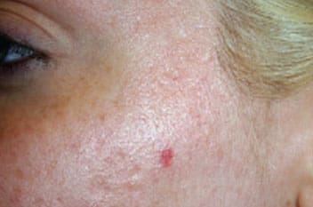 Dr. Dennis Gross Dermatology Before & After Pictures in New York, NY