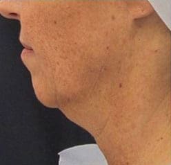 Dr. Dennis Gross Dermatology Before & After Pictures in New York, NY