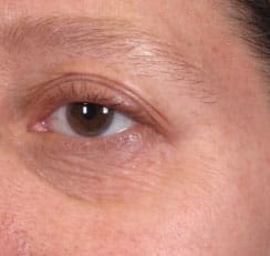 Dr. Dennis Gross Dermatology Before & After Pictures in New York, NY