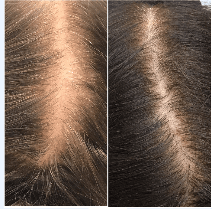 PRP for Hair Loss NYC | Dennis Gross MD Dermatology