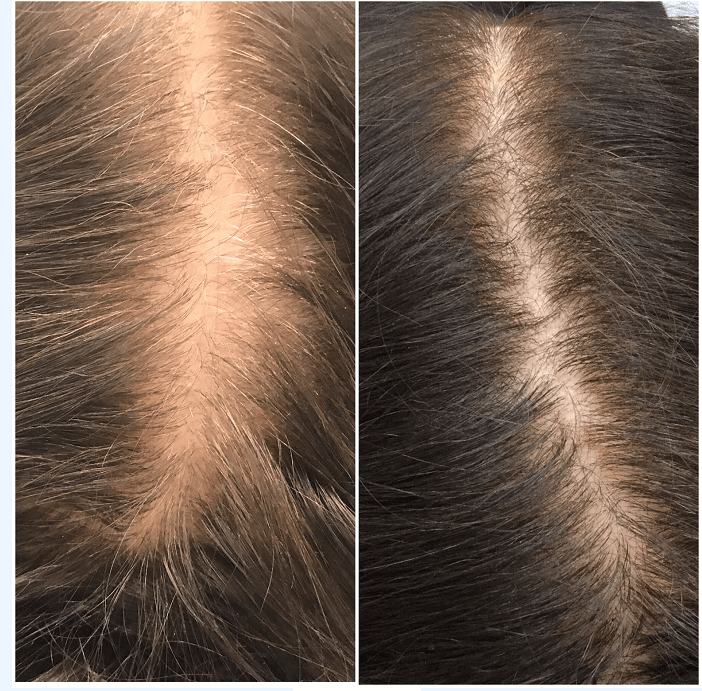 PRP for Hair Loss in New York, NY