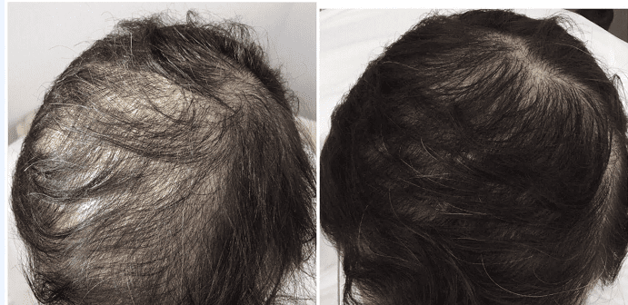 PRP for Hair Loss NYC | Dennis Gross MD Dermatology PRP for Hair Loss NYC | Dennis Gross MD Dermatology