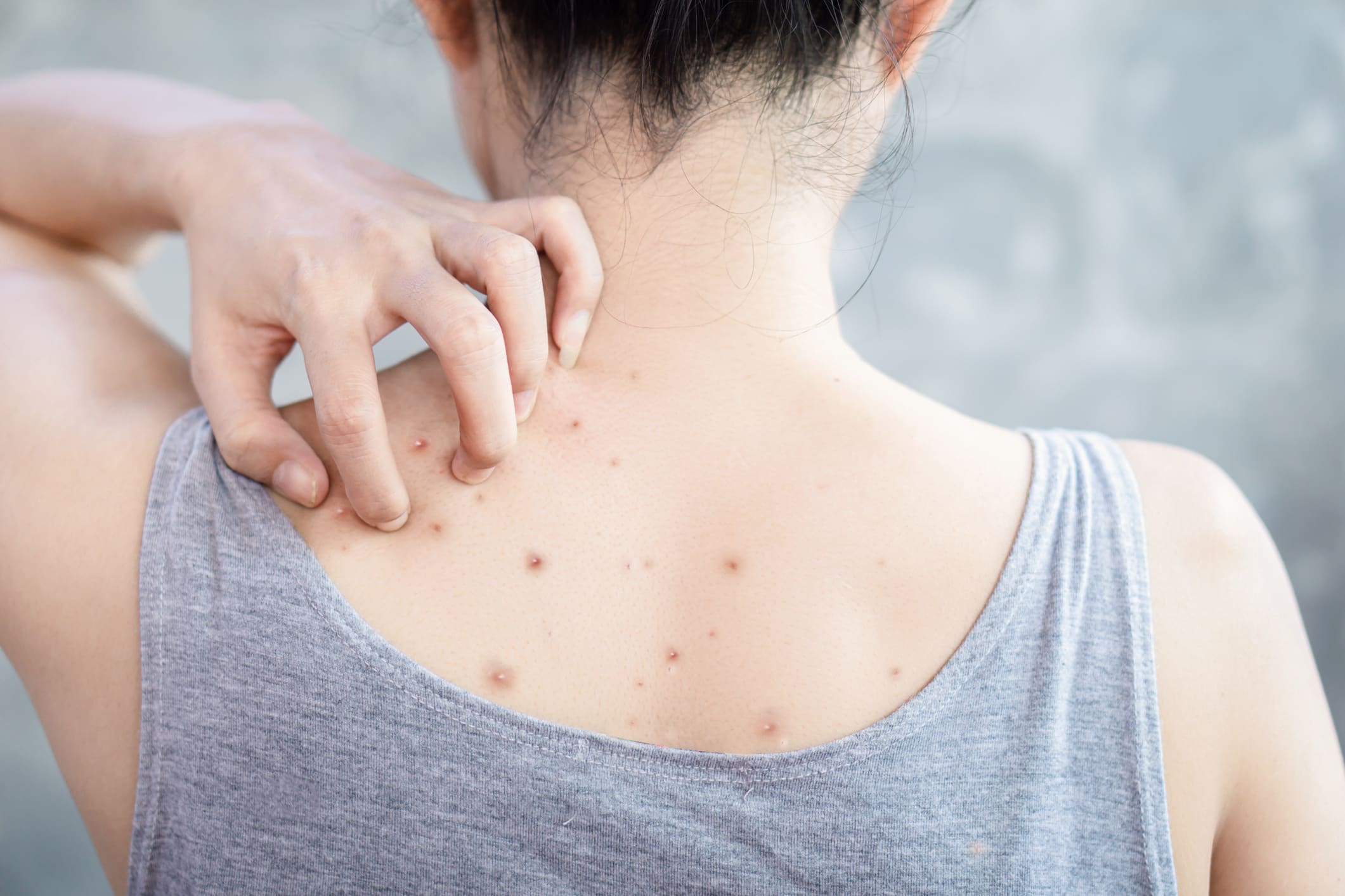 closeup woman hand scratching her skin itchy because of acne , having problem dark and red spots on back Acne Treatments in New York, NY