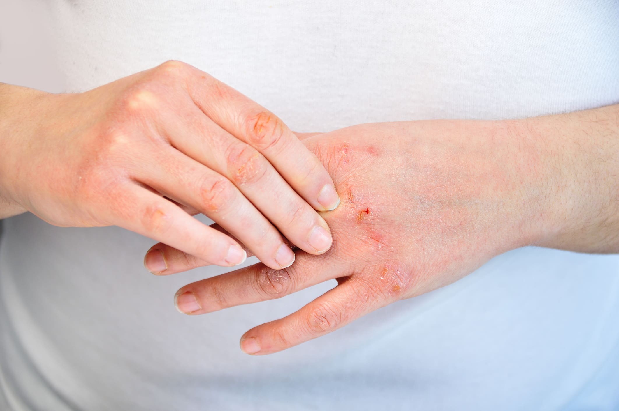 checking the hand Eczema Treatment in New York, NY