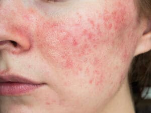 papulopustular rosacea, close-up of the patient's cheek Rosacea Treatment in New York, NY