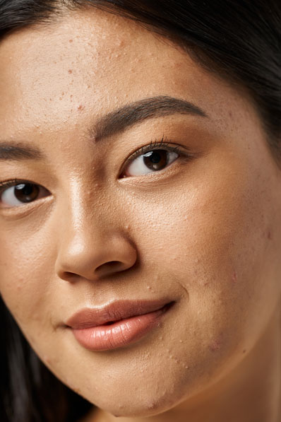 Acne Clarifying Treatment